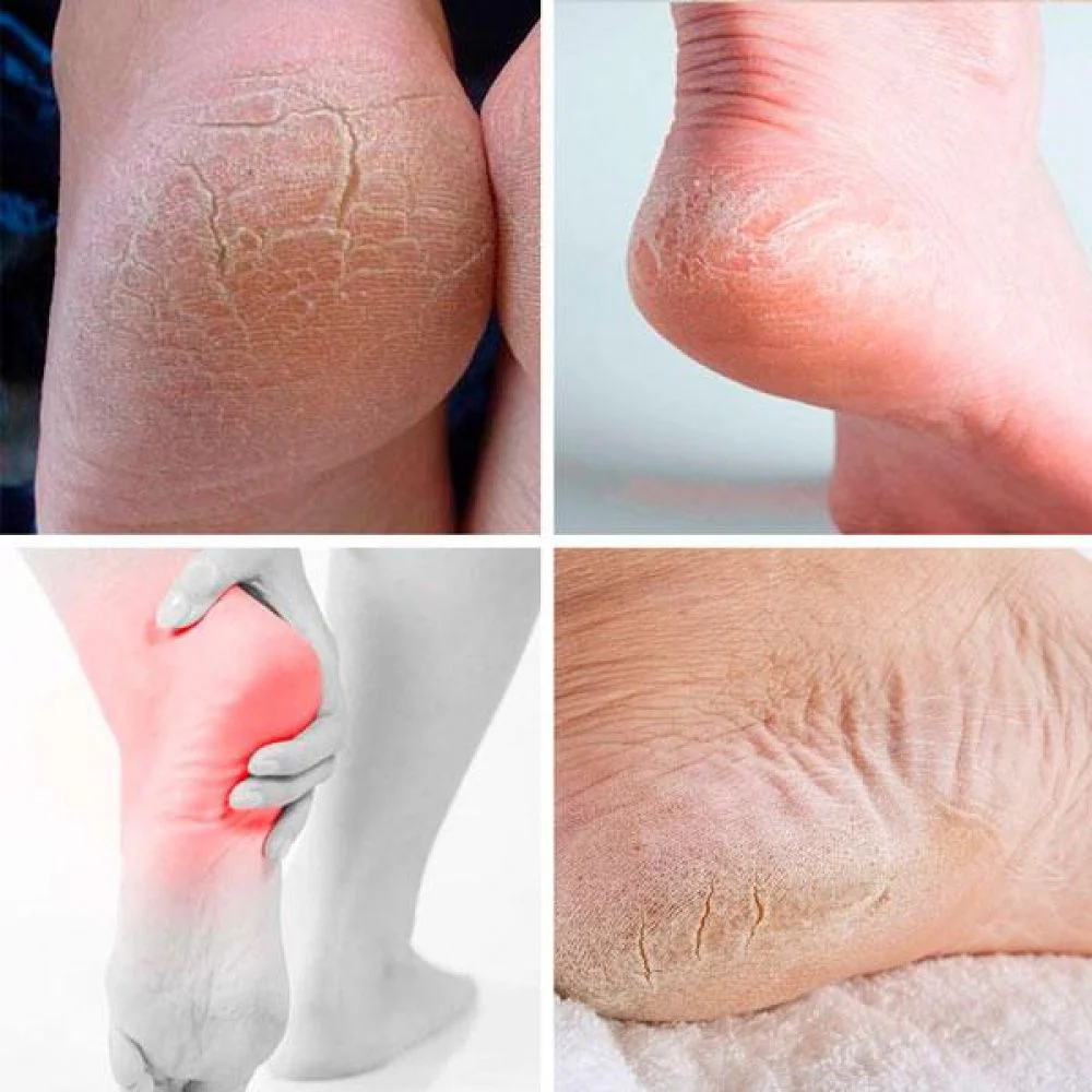Skin Foot -  Rejuvenescedor para Pés - Image 4